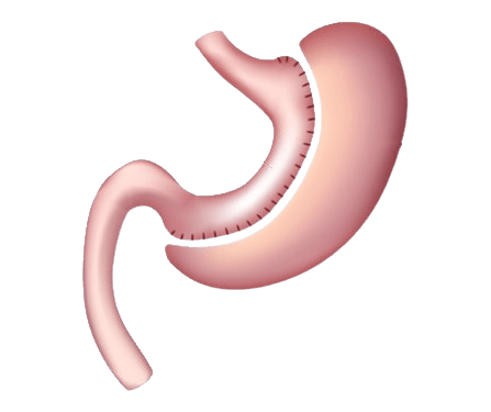 Gastric Sleeve  Surgery